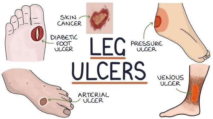 Non-Healing Ulcers Diagram
